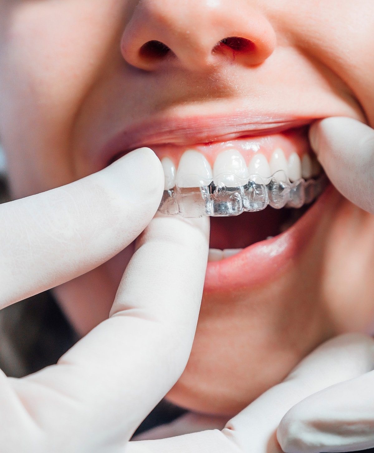 Applying clear aligner during dental treatment.
